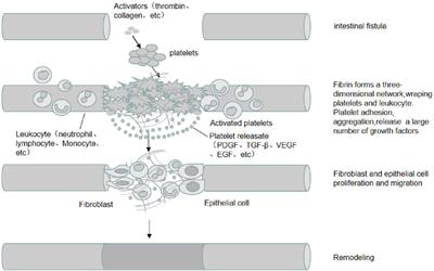 A review of platelet-rich plasma for enteric fistula management